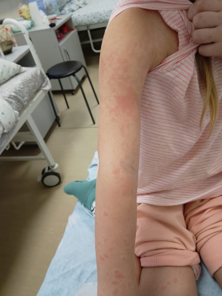 Больницы Шымкента переполнены, но чиновники отрицают, что дети массово болеют корью